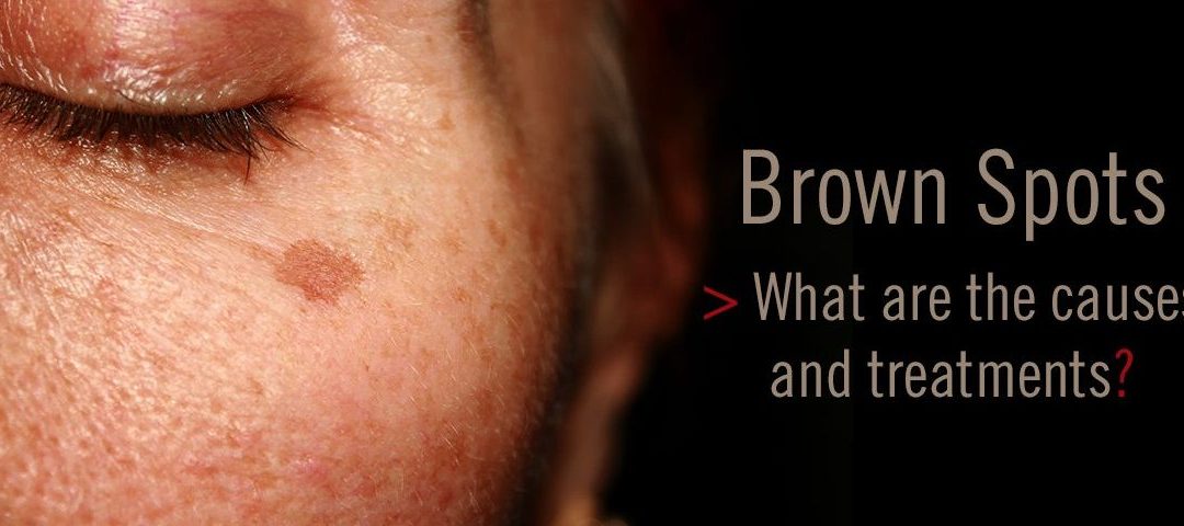 Hyperpigmentation: What is it? What causes it? How do you treat it?
