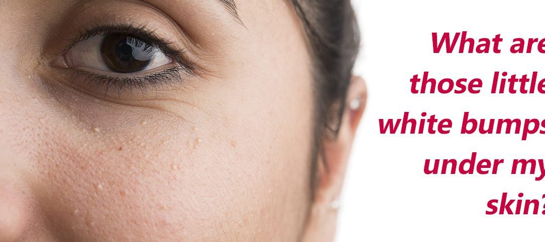 What are those little white bumps under my skin?