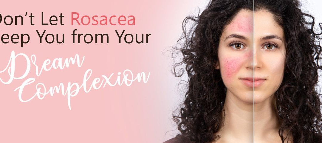 Don’t Let Rosacea Keep You from Your Dream Complexion