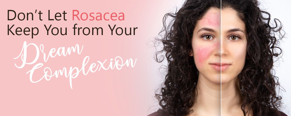 Rosacea-Blog__Graphic